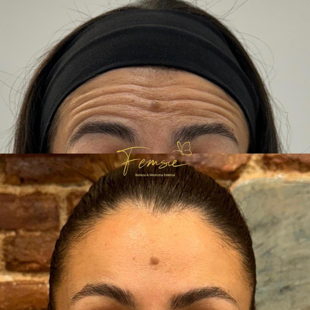 Antes y Después Arrugas 1